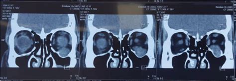 CT showed infraorbital canal enlargement due to homogenous,... | Download Scientific Diagram