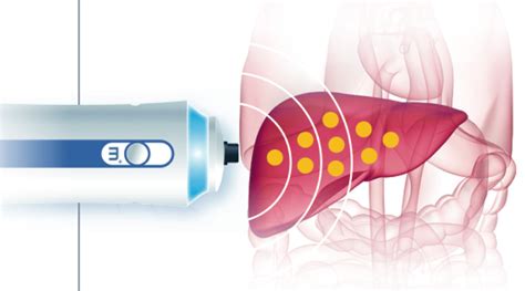 SMART SCAN , Fibroscan, Liver elastography and CAP scan ...