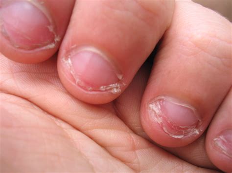 Science Says That Biting Your Nails Actually Improves Your Immune System