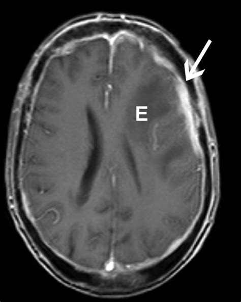 MRI with contrast. Vasogenic edema - E. Nodular dural thickening - arrow. | Download Scientific ...