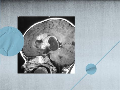 Rhabdoid tumor: Symptoms, causes, treatment, and outlook