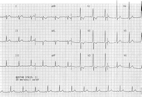 wpw ecg – maladie de wolff parkinson white – Writflx