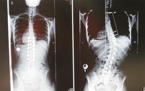 Holly Paige: My Scoliosis Story Part 2 // Surgery