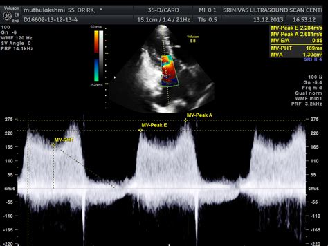 Mitral Valve Stenosis Ultrasound