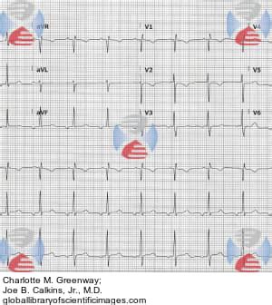 Ectopic Atrial Rhythm | Global Library of Scientific Images