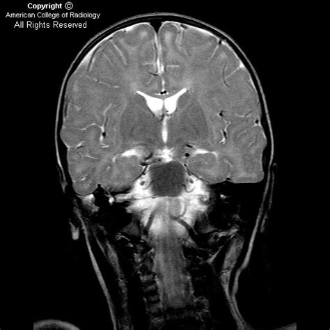 Neuroradiology On the Net: Pelizaeus Merzbacher disease (PMD)