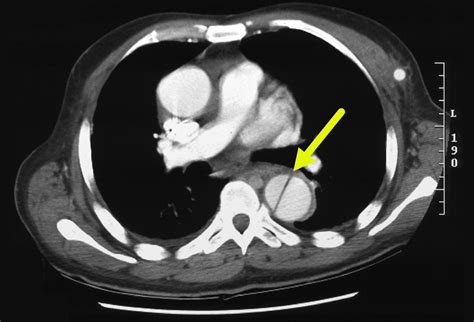 Aortic Dissection: A Double-Barreled Threat