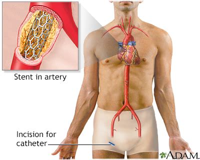 Angioplasty and stent placement - peripheral arteries - discharge ...