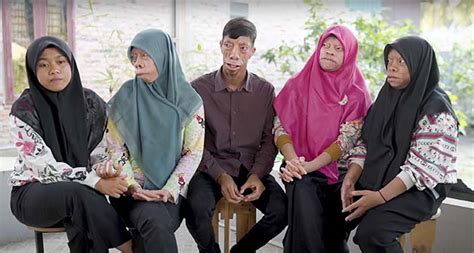 The Manurung family has a mysterious facial condition – now they ...