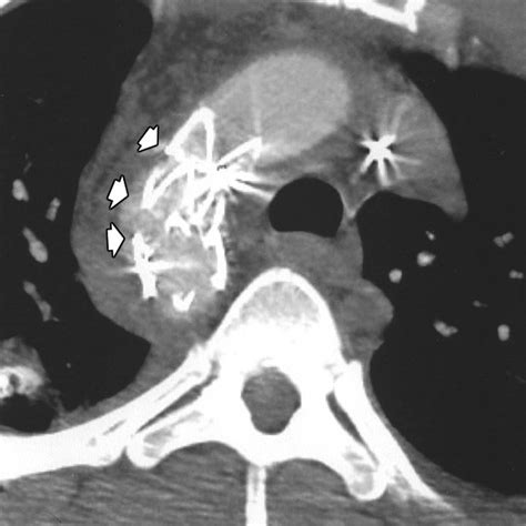 -30-year-old man (patient 14) with traumatic rupture of thoracic aorta ...