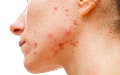 Hormonal Acne - Causes, Symptoms, Treatments – SkinKraft