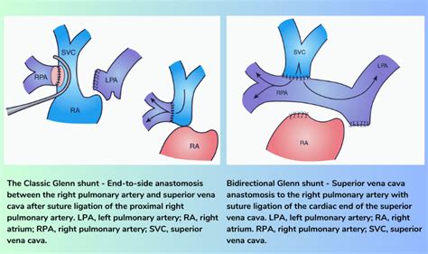 Understanding the Glenn Procedure: A Comprehensive Guide for Indian ...