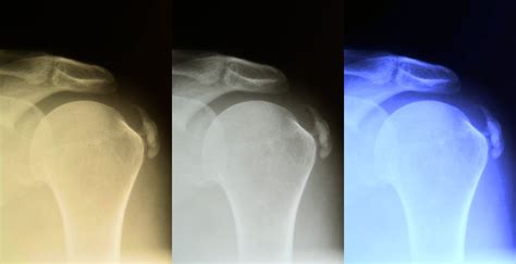 Ultrasound-Guided Shoulder Barbotage for Calcific Tendonitis