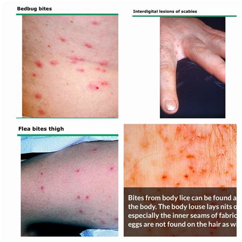 Can’t-Miss Takeaways Of Info About How To Cure Sea Lice Bites - Postmary11