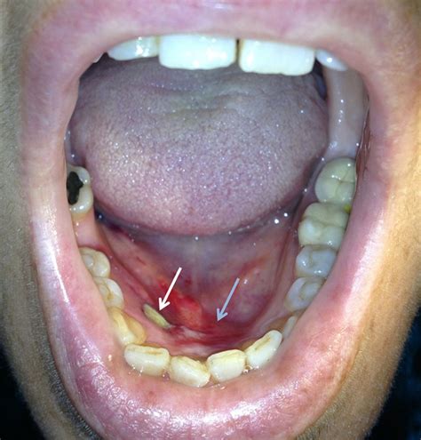 Oral lesions presenting as an early sign of acute leukaemia | BMJ Case Reports