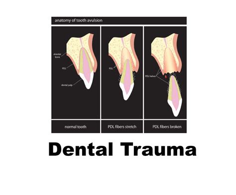 emDOCs.net – Emergency Medicine EducationManaging Dental Trauma in the Emergency Department ...