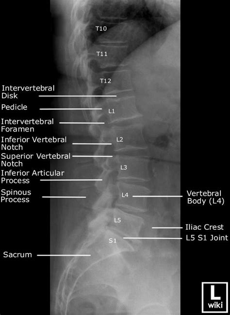 Radiographic Anatomy - Lumber Spine Lateral | Radiology imaging ...