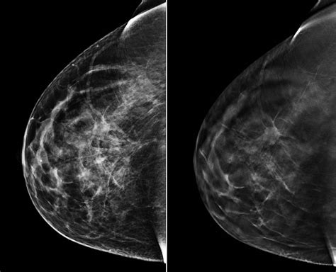 3D mammography proves highly effective in detecting cancer | health enews