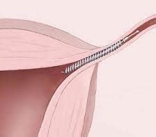 Essure Removal - Female Sterilization Reversals