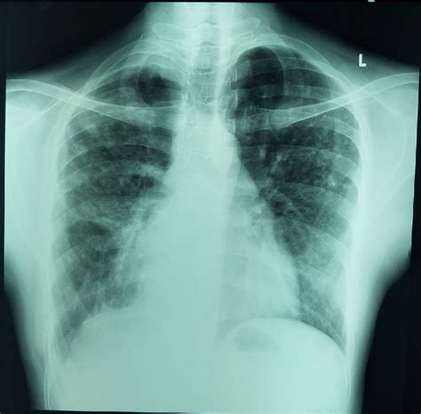 The chest radiograph showed patchy infiltrate on both lungs | Download Scientific Diagram