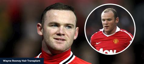 Wayne Rooney Hair Transplant - Smile Hair Clinic