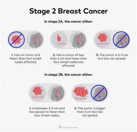 Stage 2 Breast Cancer: Outlook, Treatment, Support, and More