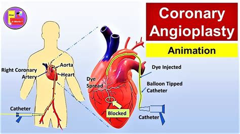 Coronary Angioplasty (Femoral Access) - Animation | Cardiac Catheterization - YouTube