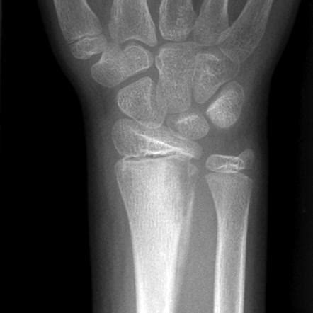 Osteomyelitis X Ray Features