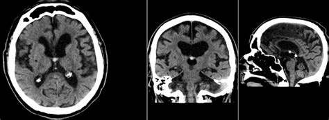 Radiology MRI: Colloid Cyst