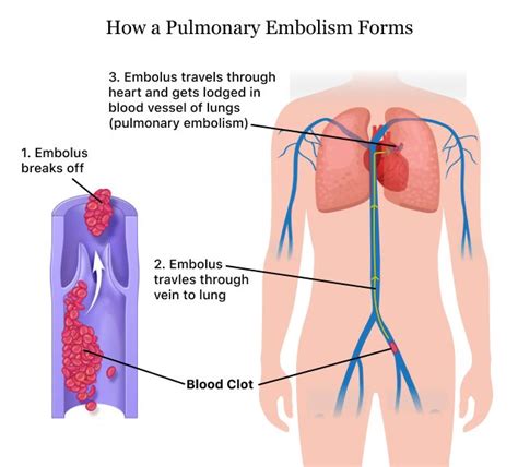 Pulmonary Embolism (PE) | Causes of a Blood Clot in the Lung