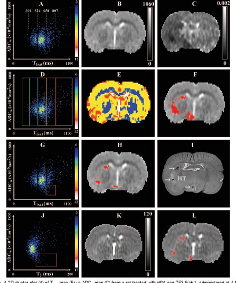 Figure 1 from Early Prediction of Gross Hemorrhagic Transformation by ...