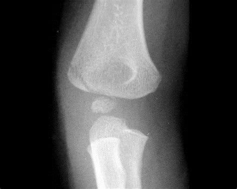 Lateral Condyle Fracture - Pediatric - Pediatrics - Orthobullets