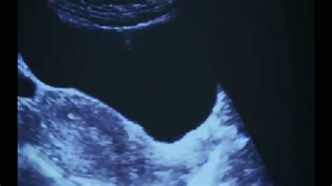 Live ectopic pregnancy with left ectopic kidney. - YouTube