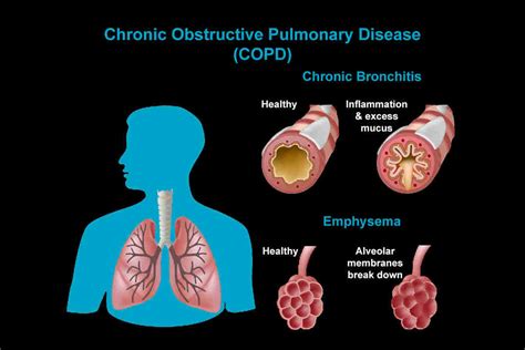 COPD: Symptoms, Causes, Types, Treatment & Prevention