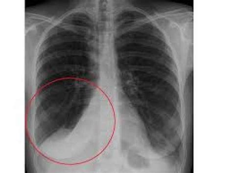 POSTHORAX - Post OP products for cardiac and thoracic surgery