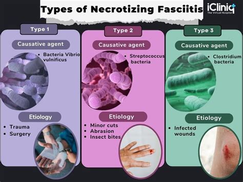 What Bacteria Causes Necrotizing Fasciitis