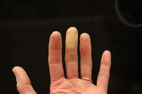 Raynaud Disease Treatment: Improving Blood Flow