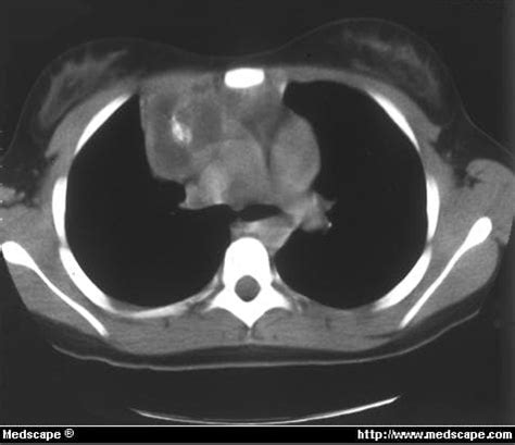 Chest Radiograph Showing Right Hilar Mass