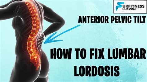 How To Fix Lumbar Lordosis and Anterior Pelvic Tilts - Full Exercise ...