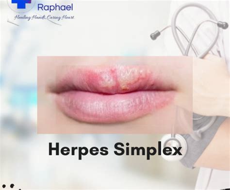 Jenis Virus Herpes yang Biasa Menyerang Manusia