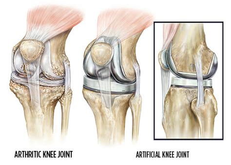 Total Knee Replacement | Summit Orthopedics