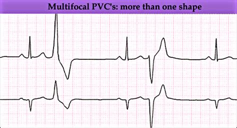 ECG Class - Keeping ECGs Simple: All about Ventricular Ectopics