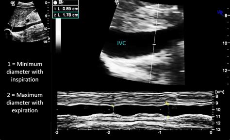 POCUS Assessment of the Inferior Vena Cava (IVC) - Point-of-Care ...