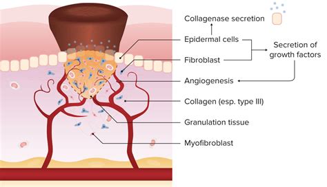 Wound Healing | Concise Medical Knowledge