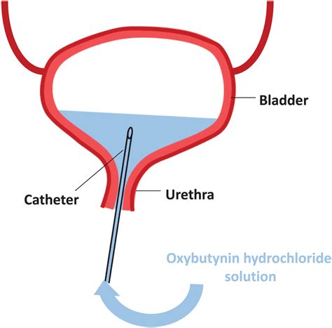 Pilot study on the effects of intravesical oxybutynin hydrochloride ...