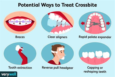 Crossbite: What Is It and How Is It Treated? (2023)