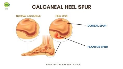 Heel Spur Treatment: The Best Ayurvedic Remedies for Pain