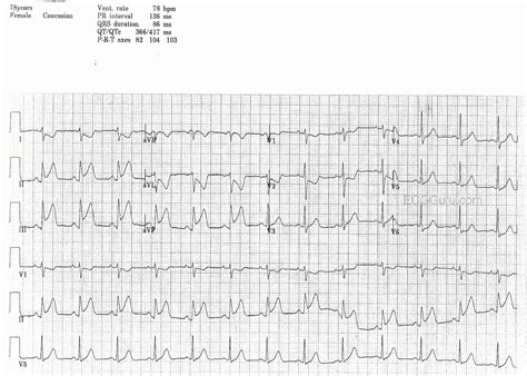 Inferior Wall M.I. | ECG Guru - Instructor Resources