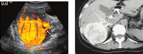 49-year-old woman with a histology-proven hepatic angiomyolipoma. (a ...