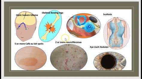 Neurofibromatosis Type 1 Causes Symptoms Treatment